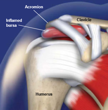 Qu Es La Bursitis Cl Nica Omnia